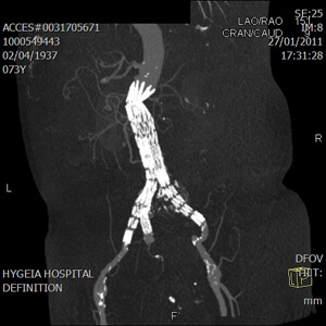 Branched Aortic Endograft