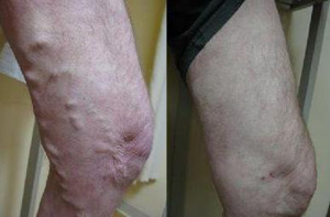 Varicose Veins Before (L) and After (R) Treatment
