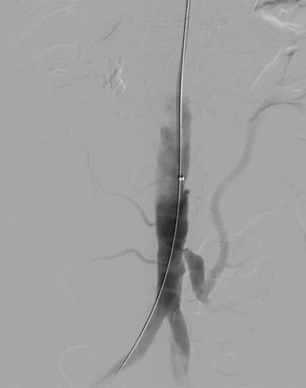HIGH IMA 1: Inferior mesenteric artery stenosis