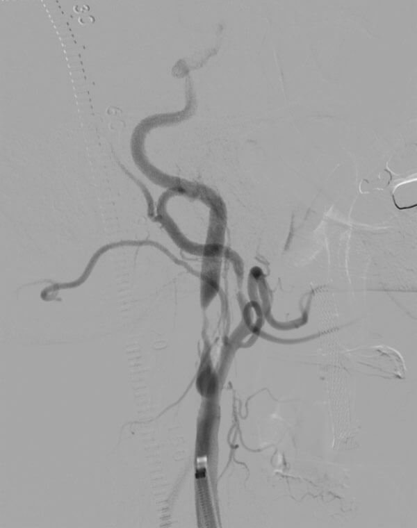 Carotid Artery Stenosis