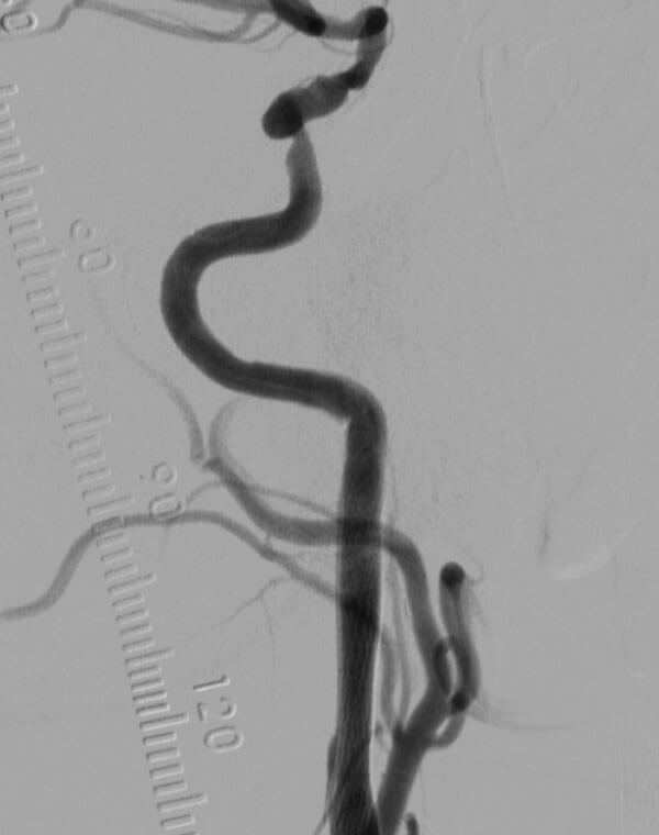 Carotid Stent