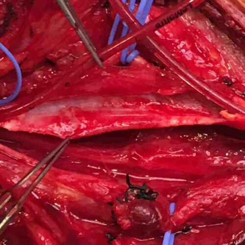 Carotid Endarterectomy