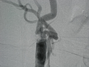 Carotid Artery Stenosis