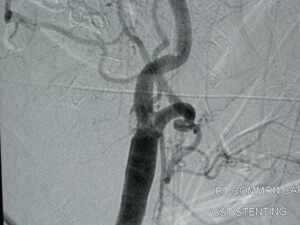 Carotid Artery Stent