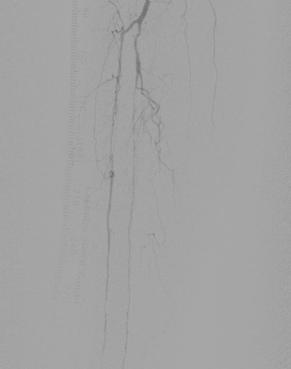 Below the Knee Arterial Stenosis