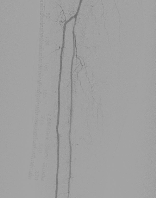 Successful Angioplasty