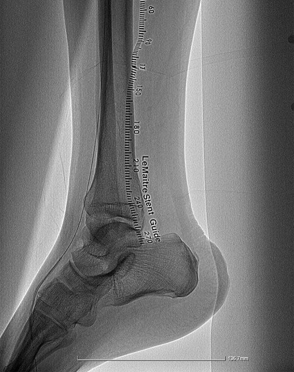 Foot Angioplasty
