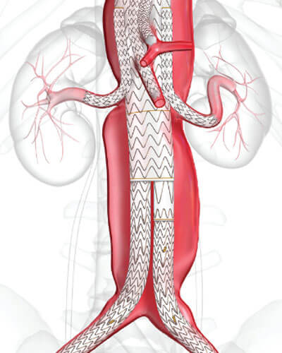 Percutaneous Aortic Endograft