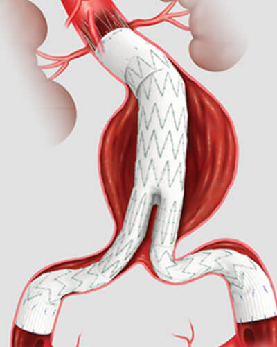 Percutaneous Aortic Endograft