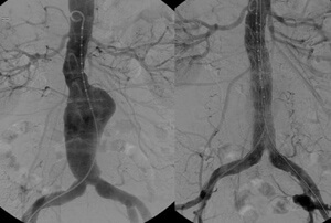 Endovascular Aneurysm Repair