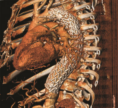 Endovascular Repair of Thoracic Aneurysm