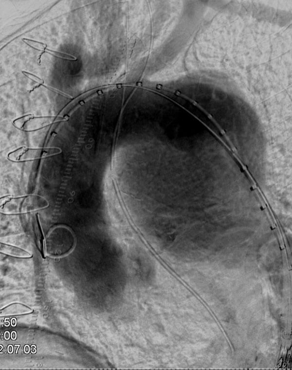 Endovascular Repair of Thoracic Aneurysm