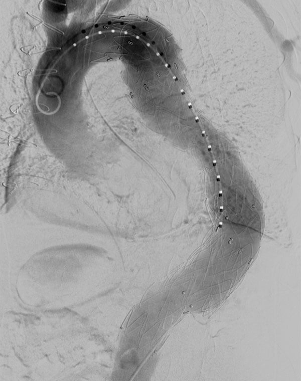 Endovascular Repair of Thoracic Aneurysm