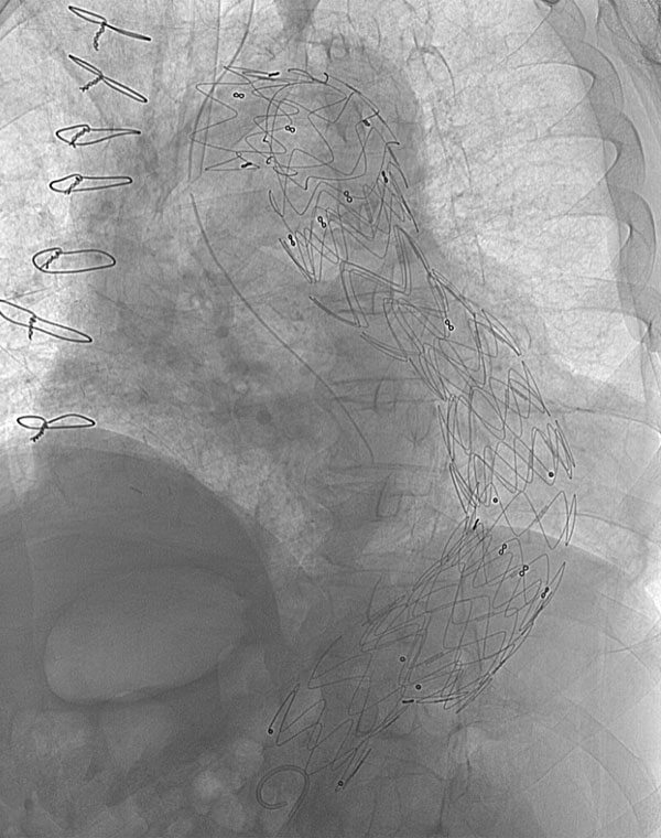 Endovascular Repair of Thoracic Aneurysm