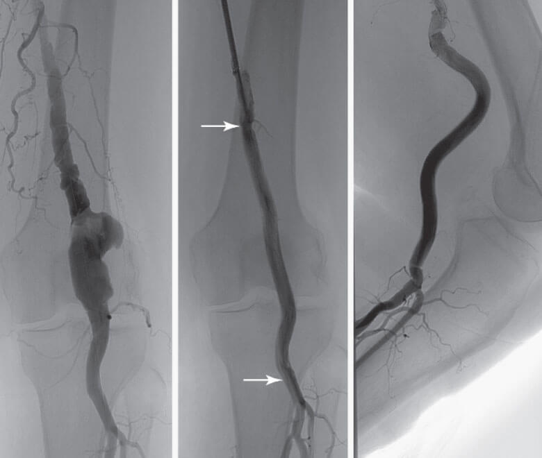 Endovascular Repair of Popliteal Aneurysm