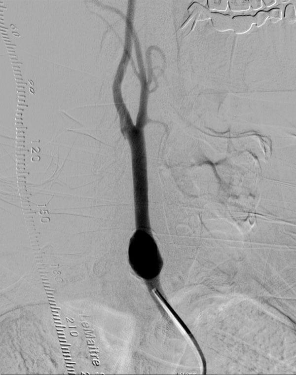 Carotid Aneurysm