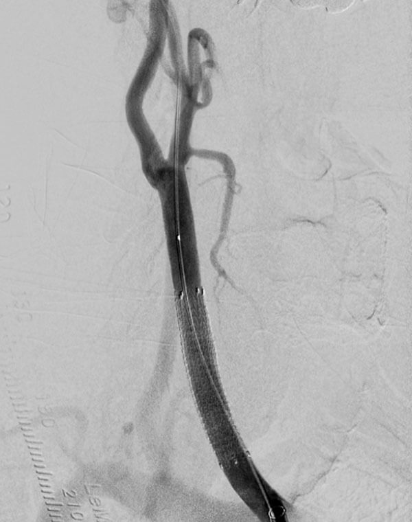 Endovascular Repair