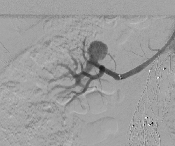 Renal Artery Aneurysm