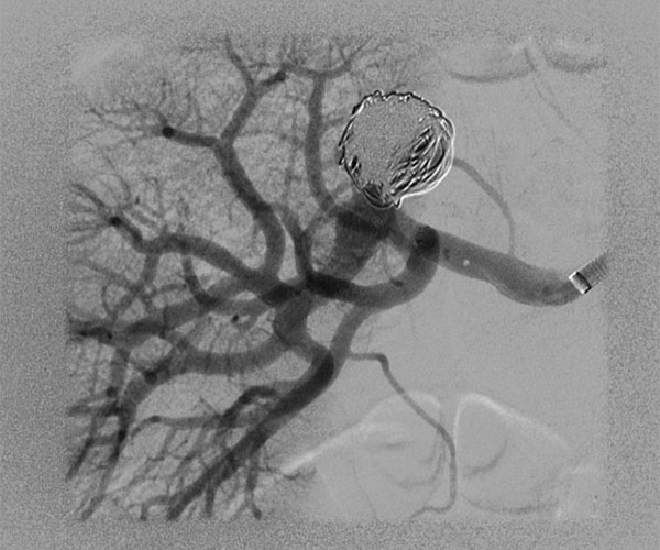 Endovascular Repair