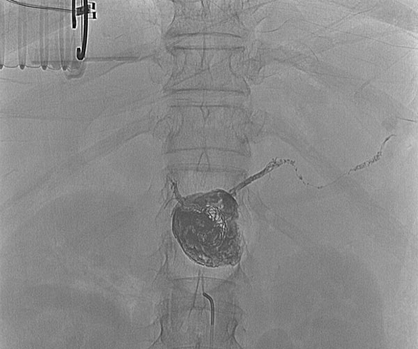 Endovascular Repair