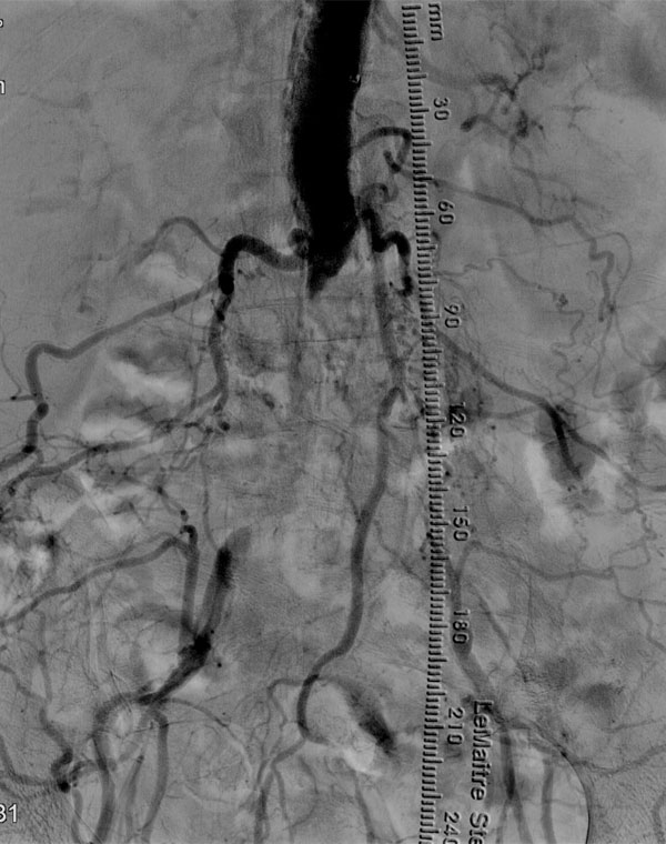 Aortic and Iliac Obstruction