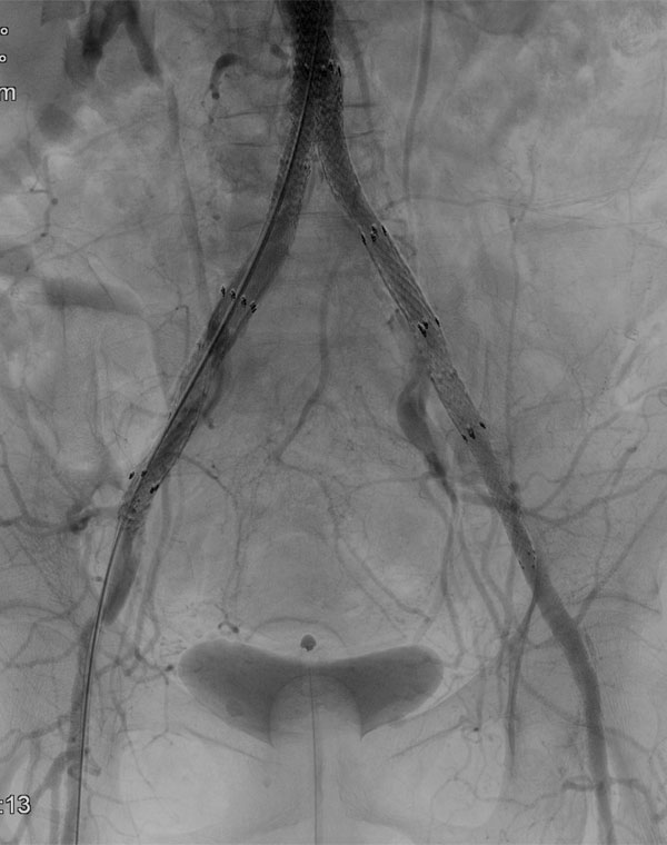 Aortic and Iliac Stent