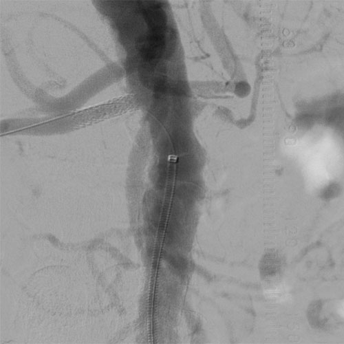 Renal Artery Stenosis