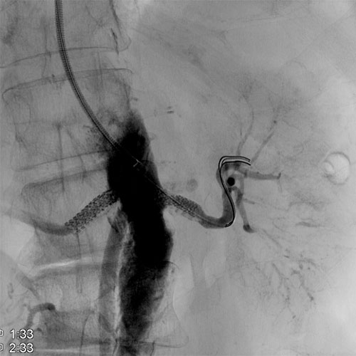 Stent Νεφρικής