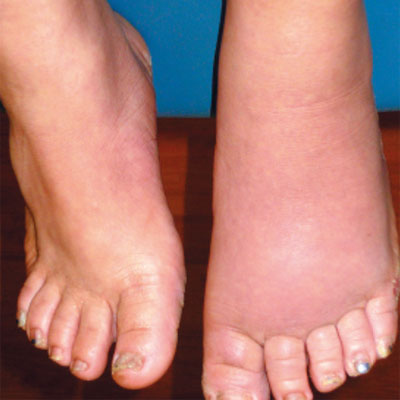 Lower Extremity Lymphedema