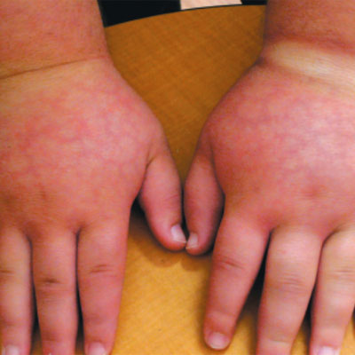 Upper Extremity Lymphedema