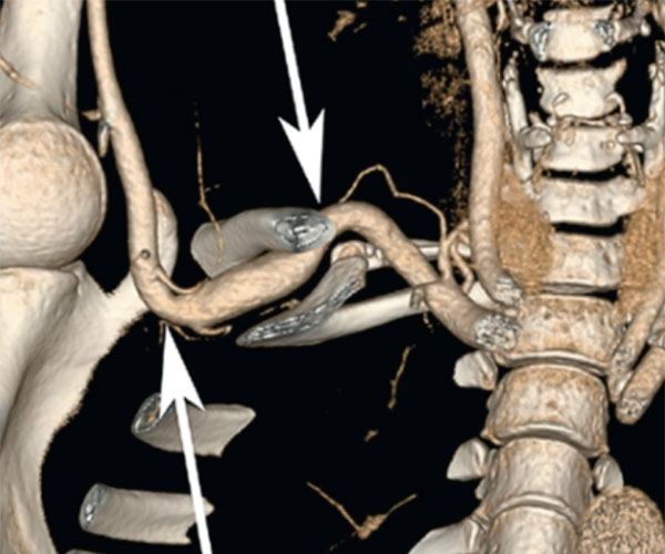 Arterial Thoracic Outlet Syndrome