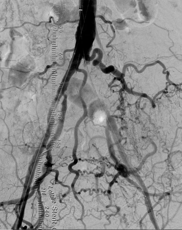 Iliac Artery Occlusion