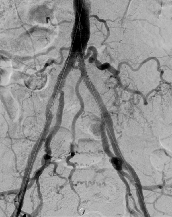 Iliac stent