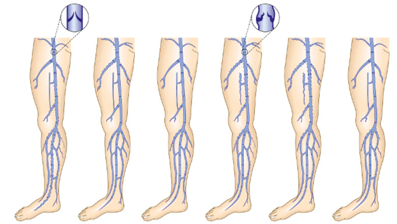 Mechanism of Varicose Veins