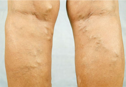 Varicose Veins