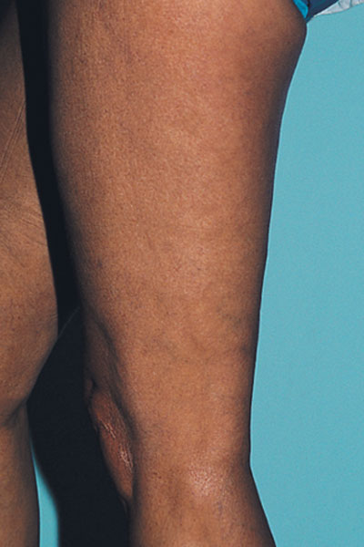 After Microsclerotherapy