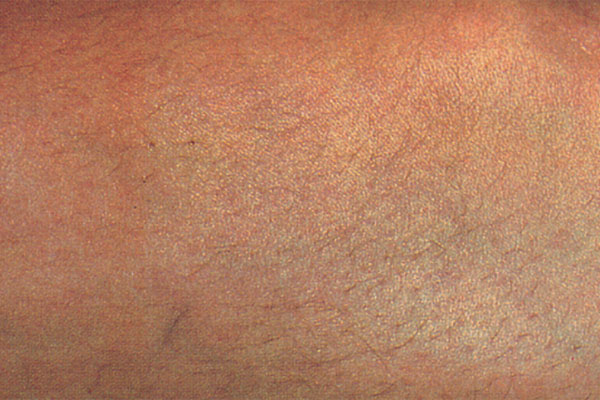 After Microsclerotherapy