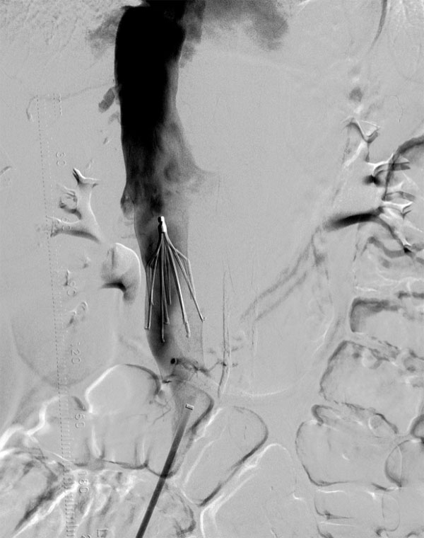 Inferior Vena Cava Filter