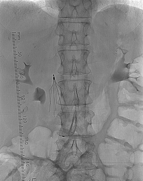 Inferior Vena Cava Filter