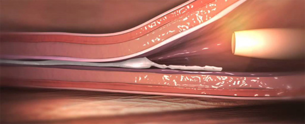 By entering the vein Venaseal Super Κόλλα polymerizes and closes the vein