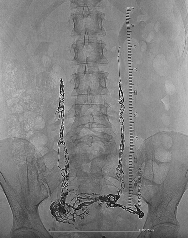 Successful Embolization