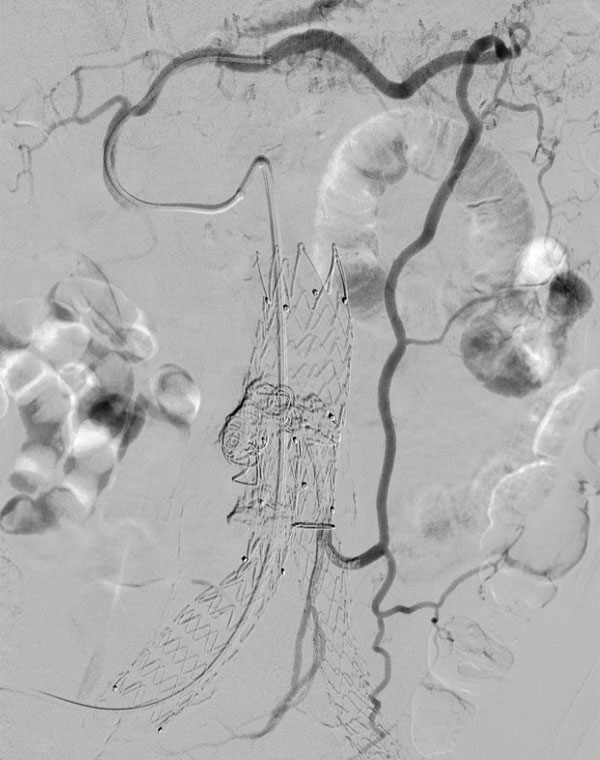 Embolization of endoleak from inferior mesenteric artery