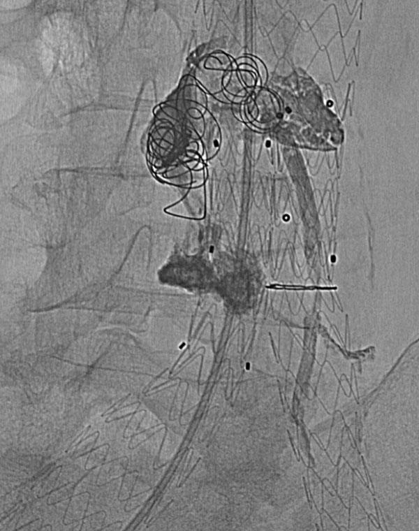 Embolization of endoleak from inferior mesenteric artery