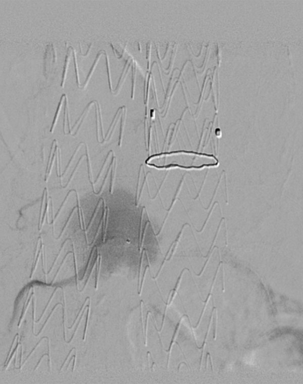 Endoleak from lumbar artery