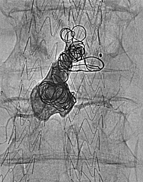 Embolization of endoleak from lumbar artery