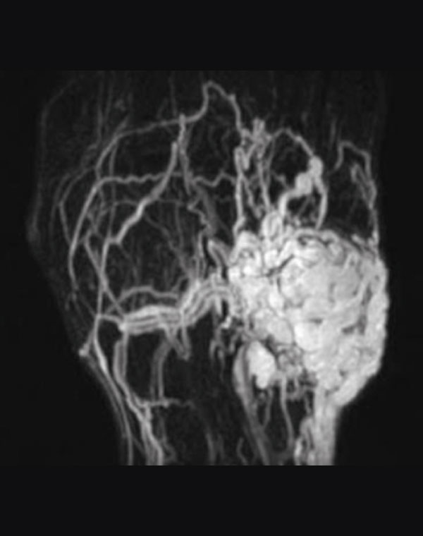 Vascular malformation of the hand