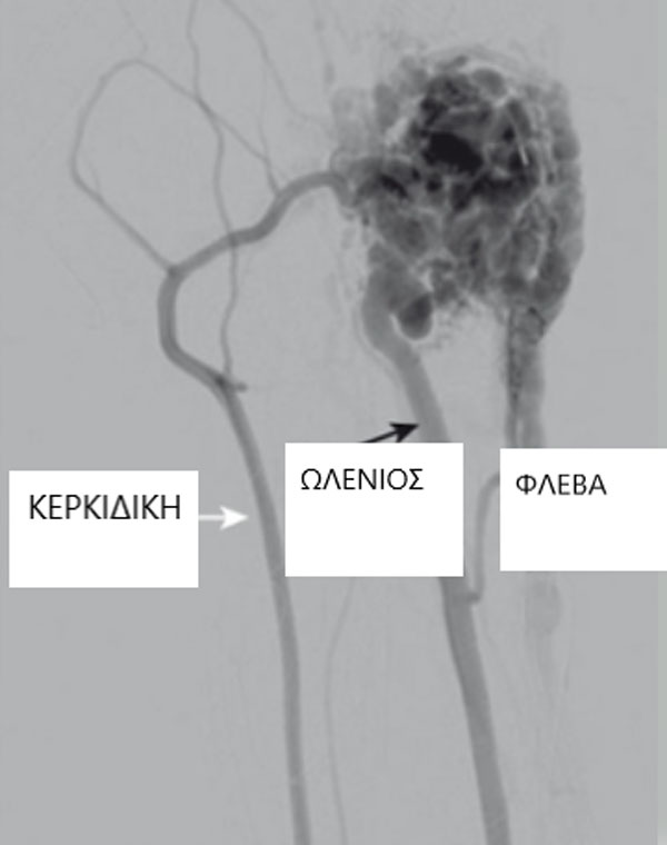 Vascular malformation of the hand