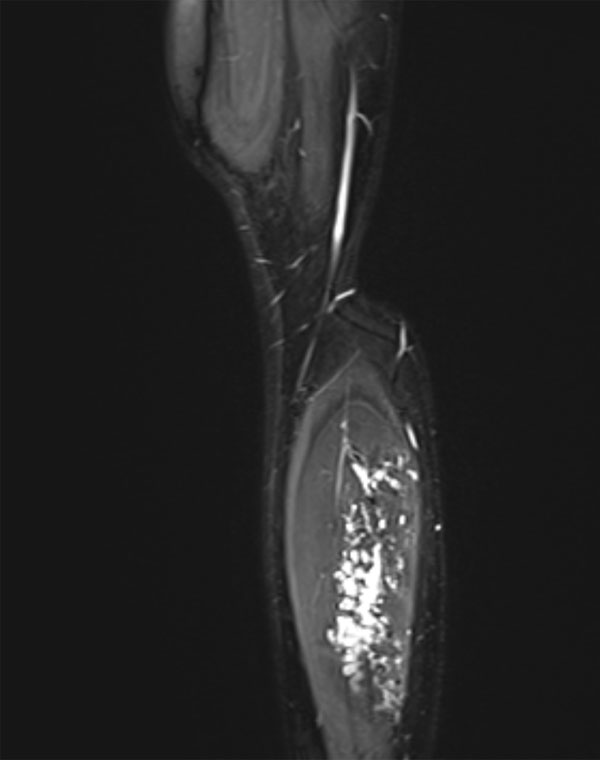Vascular malformation of the calf