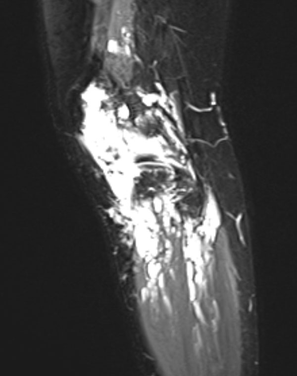 Vascular malformation of the knee