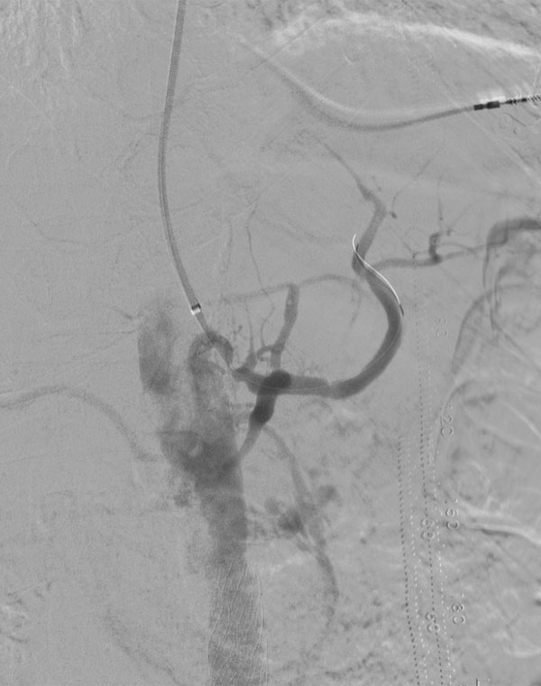 HIGH CELIAC 1: Celiac artery stenosis